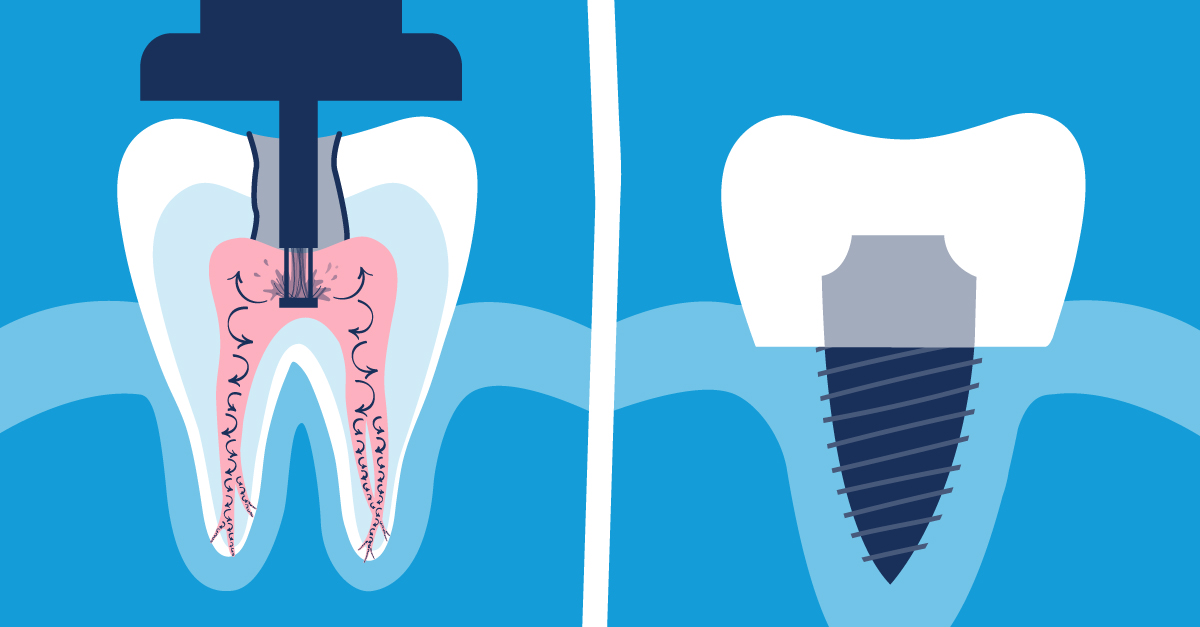 Are There Any Effective Alternatives To Root Canal Treatment?