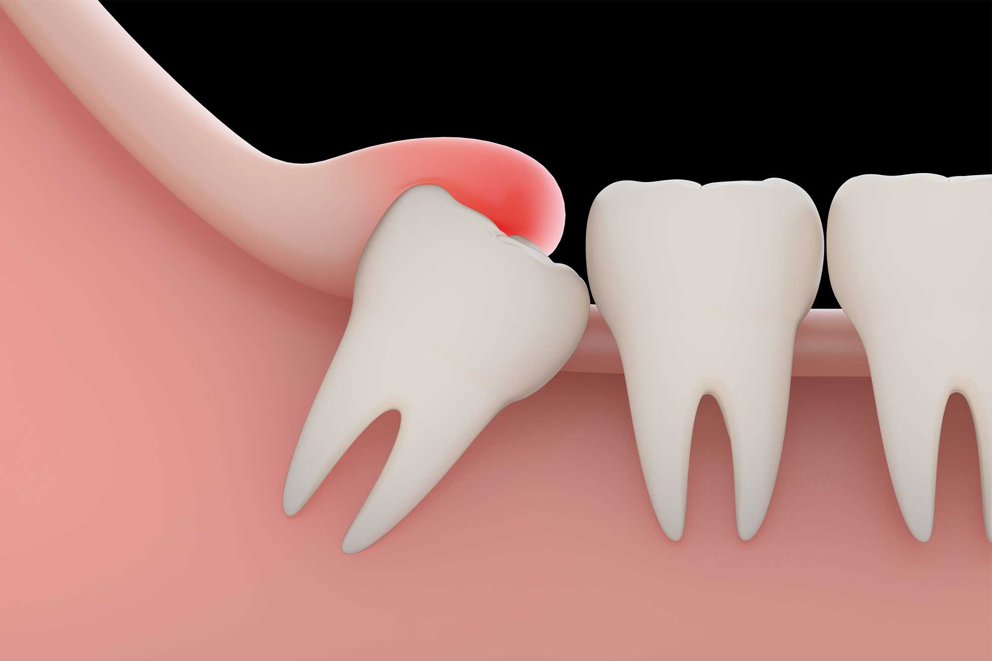 How Is Wisdom Teeth Removal Performed And What Is The Recovery Process Like?