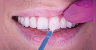 Is Fluoride Treatment Good For Your Teeth?