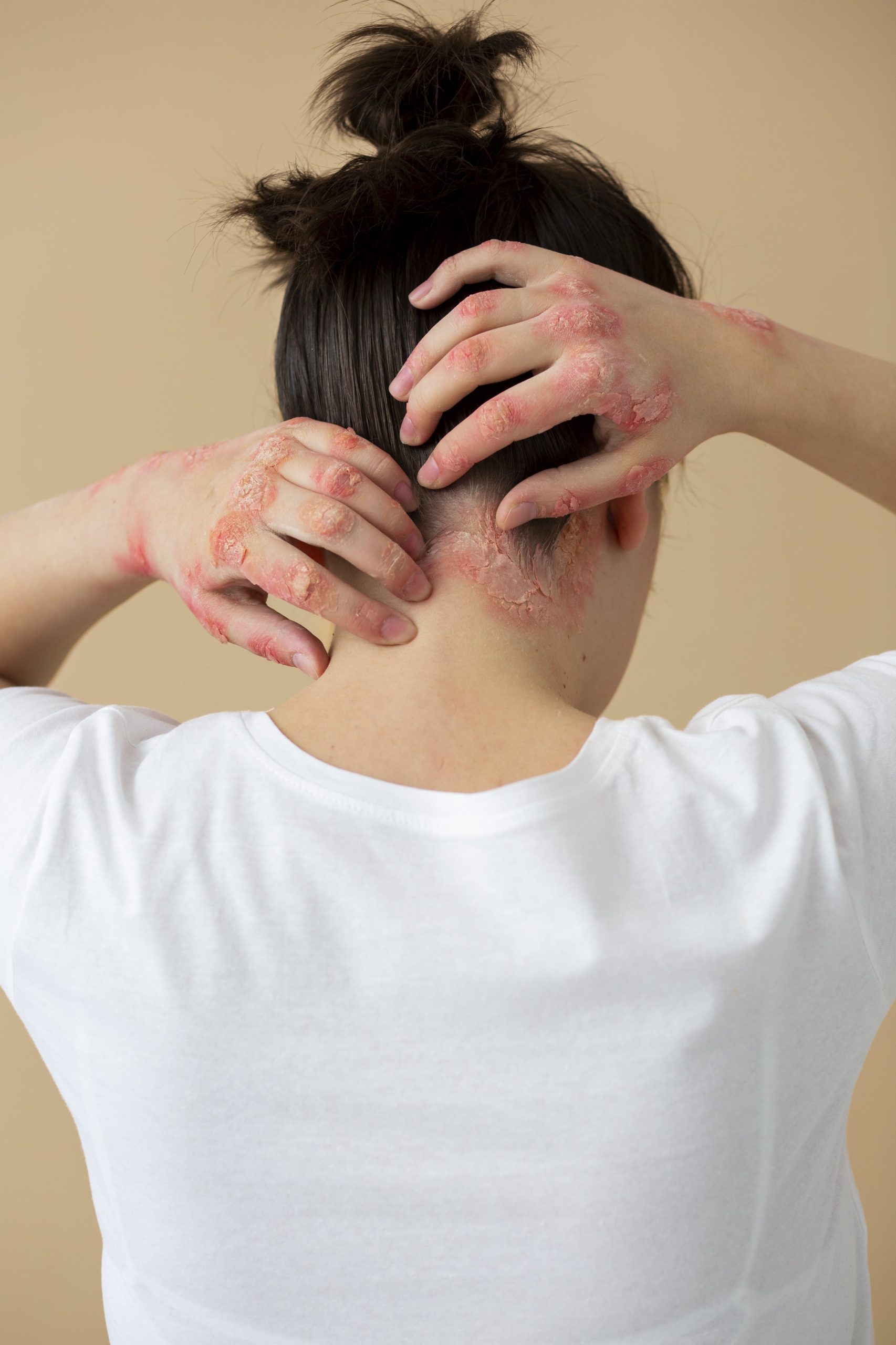 Eczema Skin Cause and Treatment
