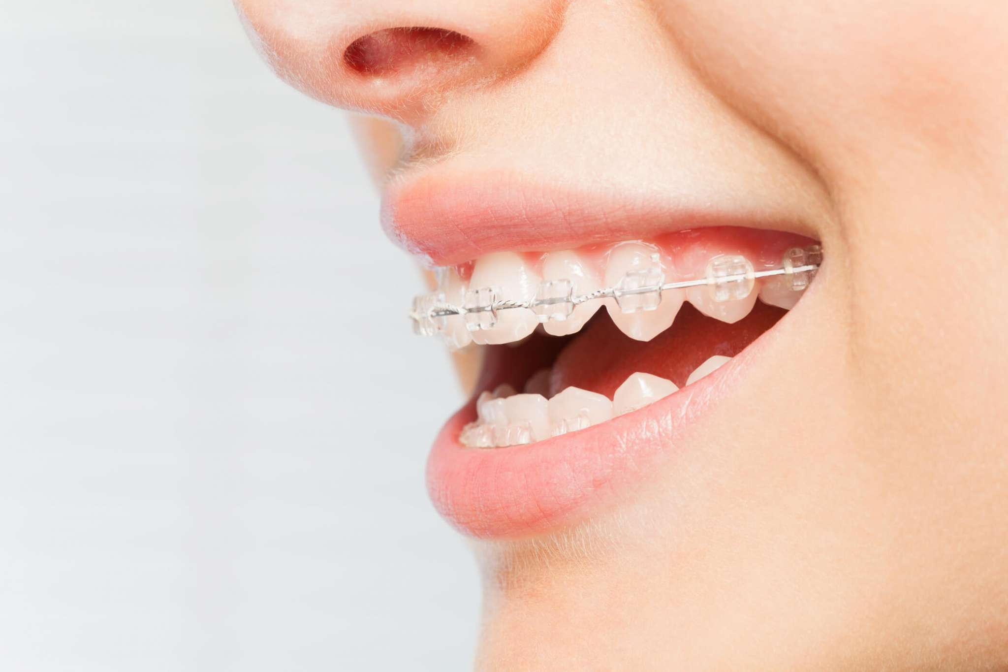 Can You Recommend Affordable Braces Providers Or Clinics?