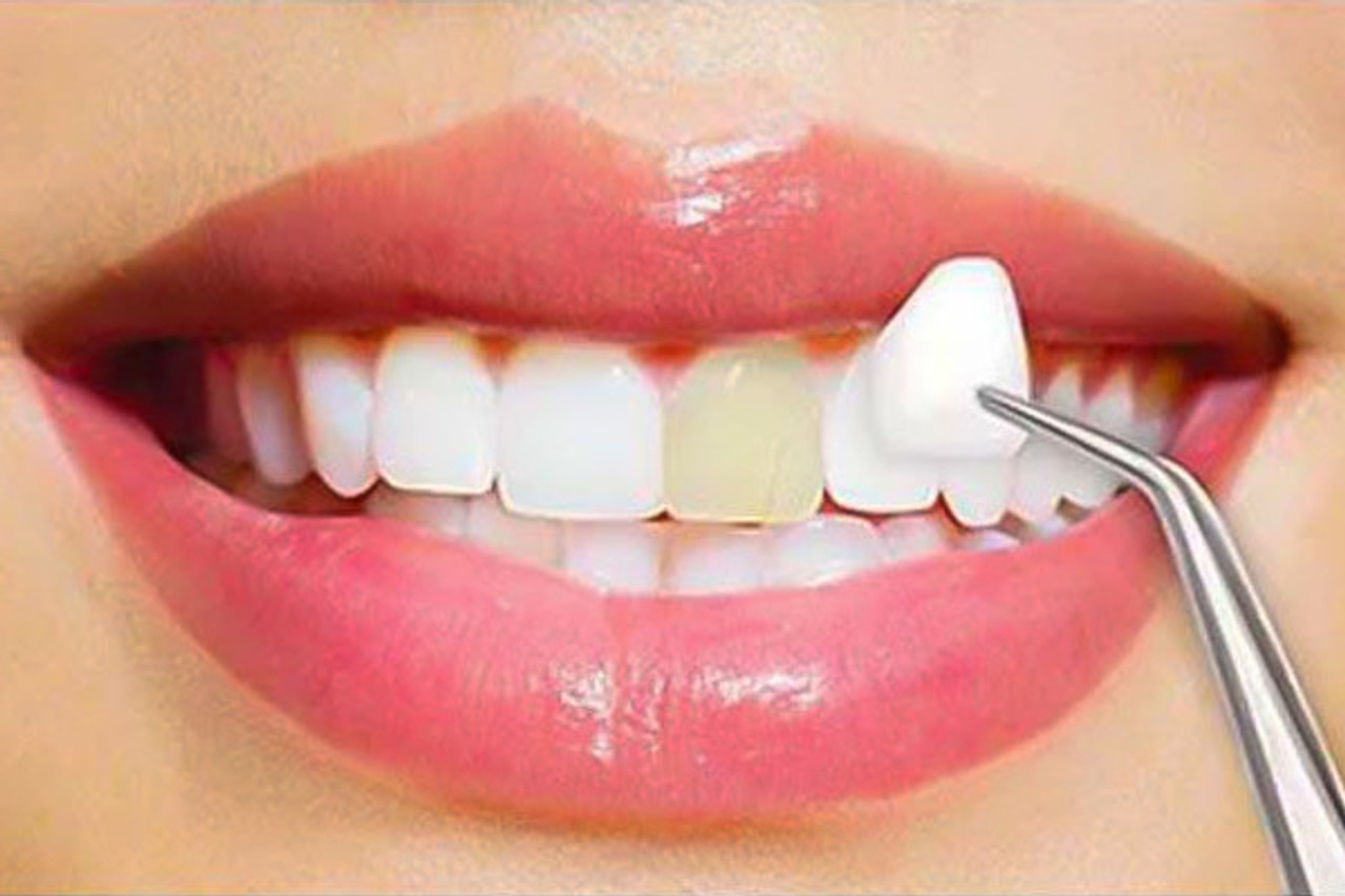 How Can Porcelain Veneers Improve The Appearance Of My Teeth?