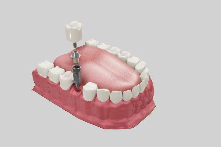 Single Tooth Implant in New York: Dental Restoration Option