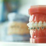 What Are The Different Types Of Underbite Braces Available?