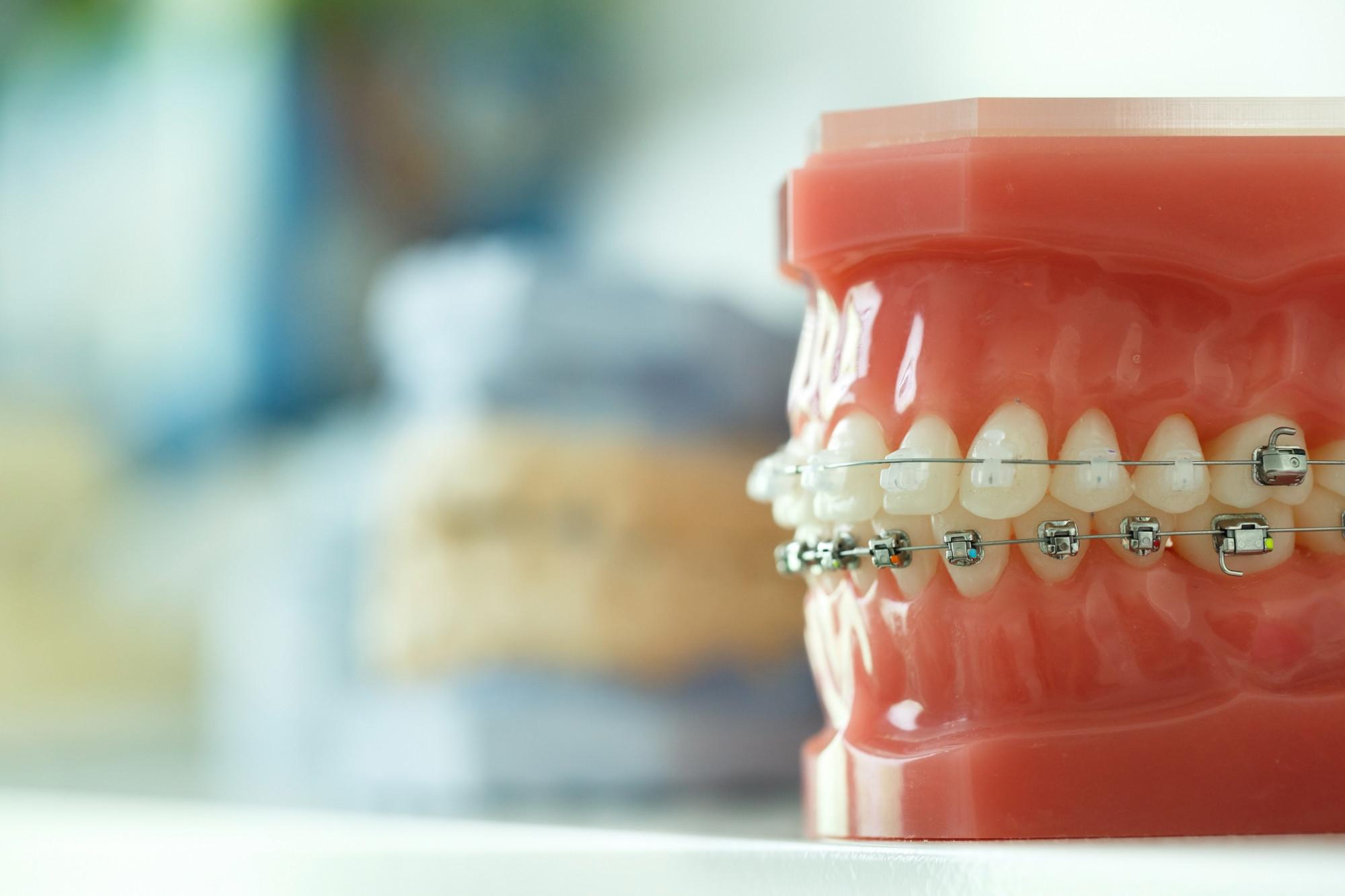 What Are The Different Types Of Underbite Braces Available?