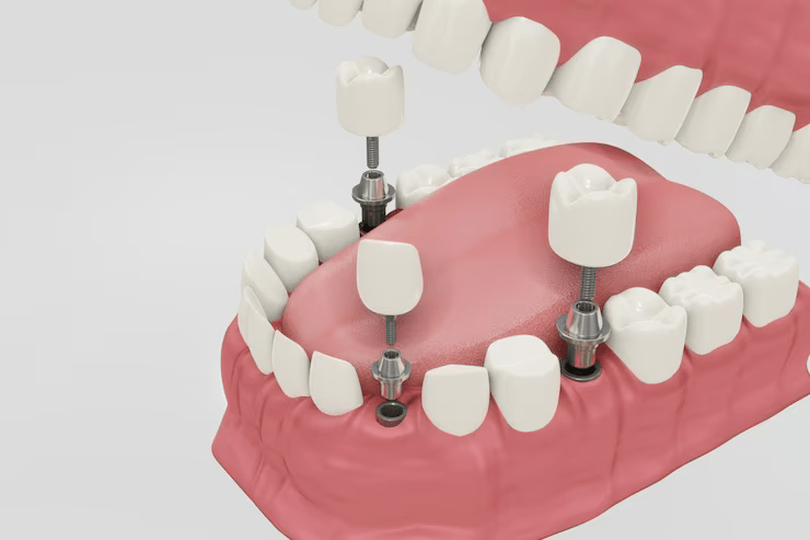 All-on-4 Implants in Lafayette, LA: Replacing Missing Teeth