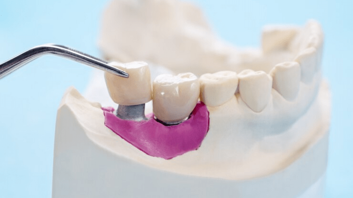 Dental Implants Lexington KY: The Key to a Confident Smile