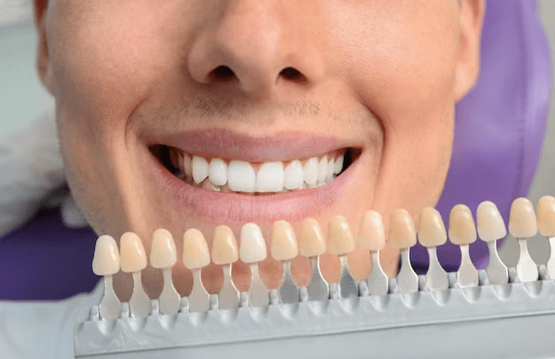 The Building Blocks of a Perfect Smile: Materials Used in Dental Veneers