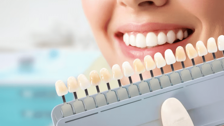 Enhance Your Smile with Dental Veneers in Athens, AL