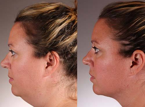 Rhinoplasty: A Solution to Breathing Problems or Cosmetic Concerns?